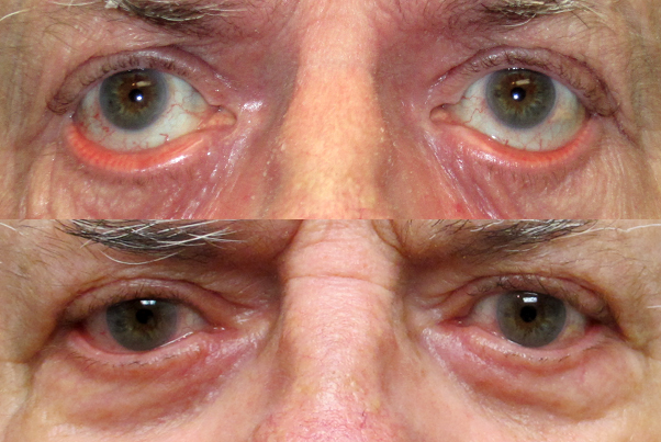 Before and After Ectropion